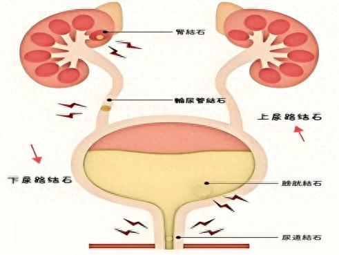 合法配资开户 永医科普丨泌尿系结石那些事儿